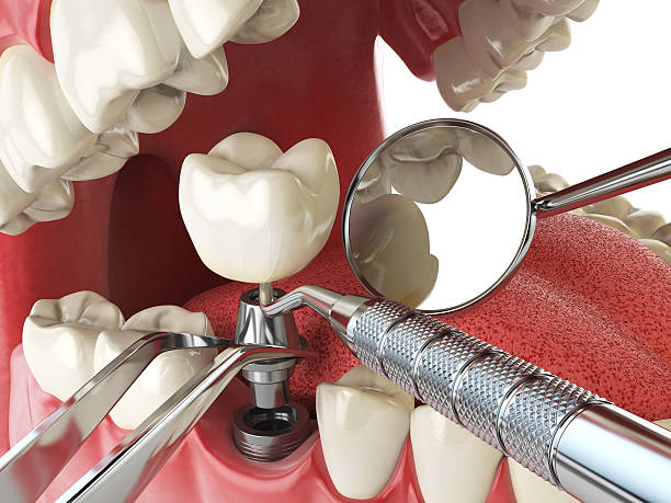 Best Emergency Root Canal Treatment in Rossmoor, CA